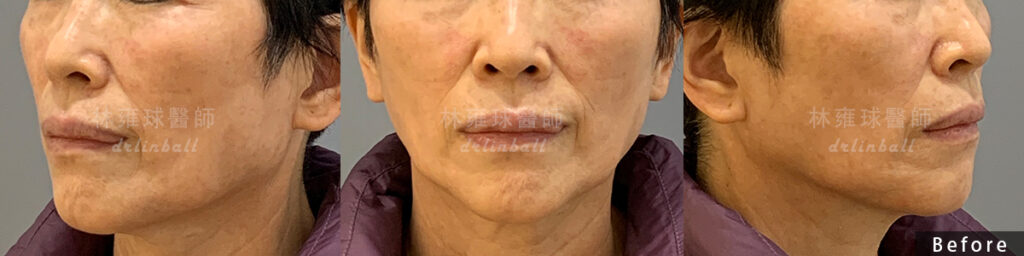補脂案例分享|全臉補脂配合「脂肪膠」,恢復肌膚膨潤、修飾臉部 補脂案例分享|全臉補脂配合「脂肪膠」,恢復肌膚膨潤、修飾臉部