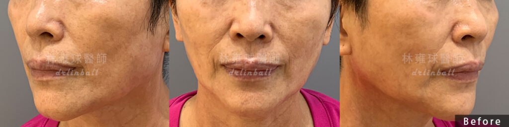 補脂案例分享|全臉補脂配合「脂肪膠」,恢復肌膚膨潤、修飾臉部 補脂案例分享|全臉補脂配合「脂肪膠」,恢復肌膚膨潤、修飾臉部